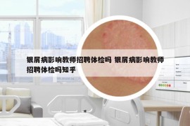 银屑病影响教师招聘体检吗 银屑病影响教师招聘体检吗知乎