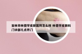 吉林市林德学皮肤医院怎么样 林德学皮肤科门诊部几点开门