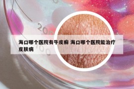 海口哪个医院有牛皮癣 海口哪个医院能治疗皮肤病