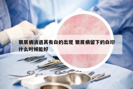 银屑病消退其有白的出现 银屑病留下的白印什么时候能好