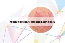 银屑癣外用特效药 银屑病效果好的外用药