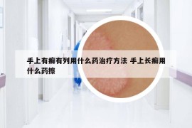 手上有癣有列用什么药治疗方法 手上长癣用什么药擦