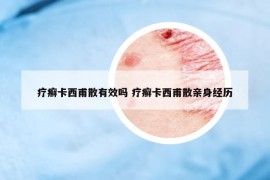 疗癣卡西甫散有效吗 疗癣卡西甫散亲身经历