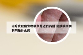 治疗皮肤病生物制剂是进口药剂 皮肤病生物制剂是什么药