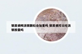 银屑病喝消银颗粒会加重吗 银屑病可以吃消银胶囊吗