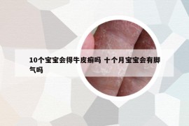 10个宝宝会得牛皮癣吗 十个月宝宝会有脚气吗