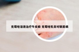 克霉唑溶液治疗牛皮癣 克霉唑乳膏对银屑病