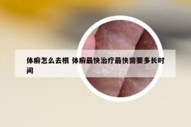 体癣怎么去根 体癣最快治疗最快需要多长时间