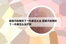 屁股沟右侧长了一片癣怎么治 屁股沟右侧长了一片癣怎么治疗好