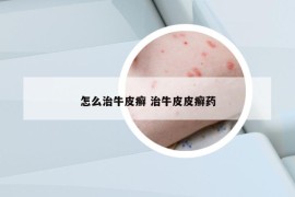 怎么治牛皮癣 治牛皮皮癣药