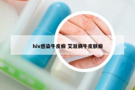 hiv感染牛皮癣 艾滋病牛皮肤癣