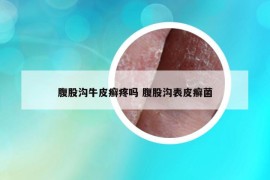 腹股沟牛皮癣疼吗 腹股沟表皮癣菌