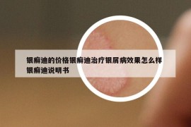 银癣迪的价格银癣迪治疗银屑病效果怎么样 银癣迪说明书