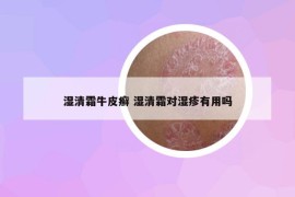 湿清霜牛皮癣 湿清霜对湿疹有用吗