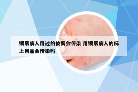 银屑病人用过的被褥会传染 用银屑病人的床上用品会传染吗