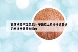 银屑病服甲泼尼龙片 甲泼尼龙片治疗银屑病的用法用量是怎样的