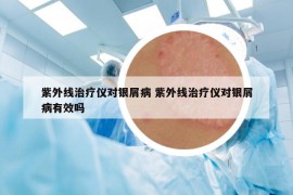 紫外线治疗仪对银屑病 紫外线治疗仪对银屑病有效吗