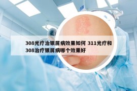 308光疗治银屑病效果如何 311光疗和308治疗银屑病哪个效果好