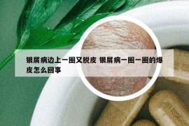 银屑病边上一圈又脱皮 银屑病一圈一圈的爆皮怎么回事