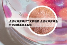 点滴状银屑病好了又长新的 点滴状银屑病治疗期间又出现小丘疹