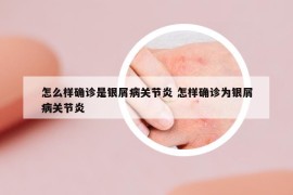 怎么样确诊是银屑病关节炎 怎样确诊为银屑病关节炎