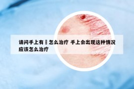 请问手上有廯怎么治疗 手上会出现这种情况应该怎么治疗