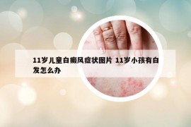 11岁儿童白癜风症状图片 11岁小孩有白发怎么办