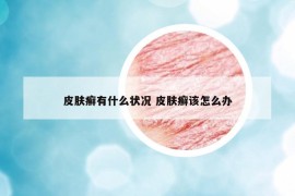 皮肤癣有什么状况 皮肤癣该怎么办