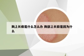 胸上长癣是什么怎么办 胸部上长藓是因为什么