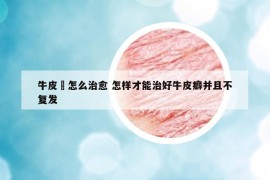 牛皮廯怎么治愈 怎样才能治好牛皮癖并且不复发