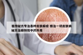 祖传秘方专治各种皮肤癣症 根治一切皮肤病秘方治癣特效中药外用