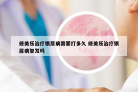 修美乐治疗银屑病需要打多久 修美乐治疗银屑病复发吗