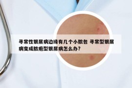 寻常性银屑病边缘有几个小脓包 寻常型银屑病变成脓疱型银屑病怎么办?