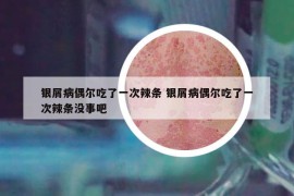 银屑病偶尔吃了一次辣条 银屑病偶尔吃了一次辣条没事吧