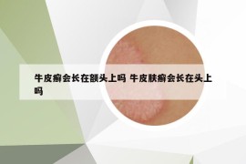 牛皮癣会长在额头上吗 牛皮肤癣会长在头上吗