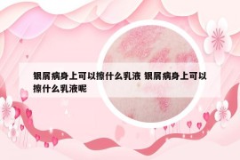 银屑病身上可以擦什么乳液 银屑病身上可以擦什么乳液呢