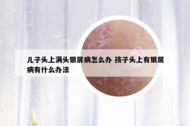 儿子头上满头银屑病怎么办 孩子头上有银屑病有什么办法