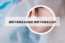 腋窝下有癣怎么引起的 腋窝下长癣怎么治疗