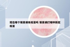 现在哪个银屑病有疫苗吗 银屑病打哪种新冠疫苗