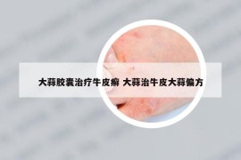 大蒜胶囊治疗牛皮癣 大蒜治牛皮大蒜偏方