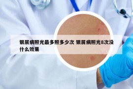 银屑病照光最多照多少次 银屑病照光8次没什么效果