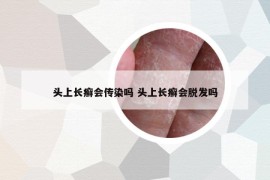 头上长癣会传染吗 头上长癣会脱发吗