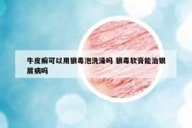 牛皮癣可以用狼毒泡洗澡吗 狼毒软膏能治银屑病吗