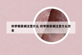 秋季银屑病注意什么 秋季银屑病注意什么饮食