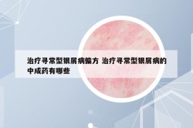 治疗寻常型银屑病偏方 治疗寻常型银屑病的中成药有哪些