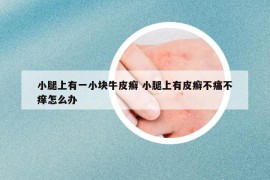 小腿上有一小块牛皮癣 小腿上有皮癣不痛不痒怎么办