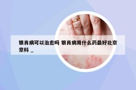 银肖病可以治愈吗 银肖病用什么药最好北京京科 _