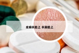 皮癣长脸上 长藓脸上