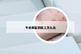 牛皮癣起到脸上怎么治