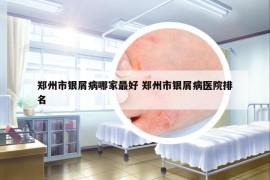 郑州市银屑病哪家最好 郑州市银屑病医院排名